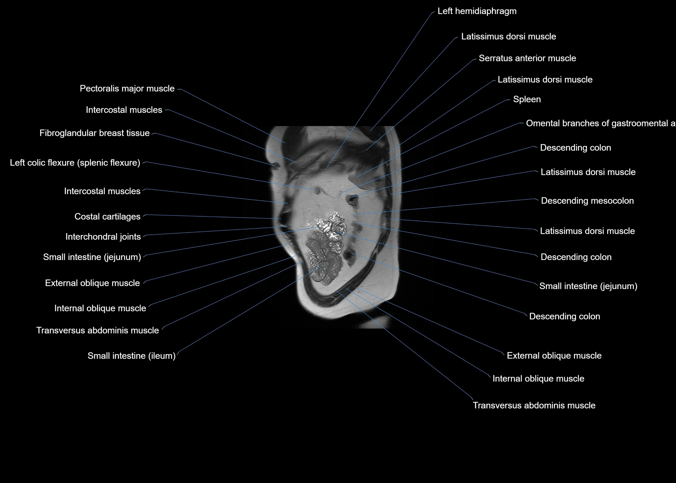 MRI abdomen sagittal cross sectional anatomy  radiology  image-img-00001-00061.webp